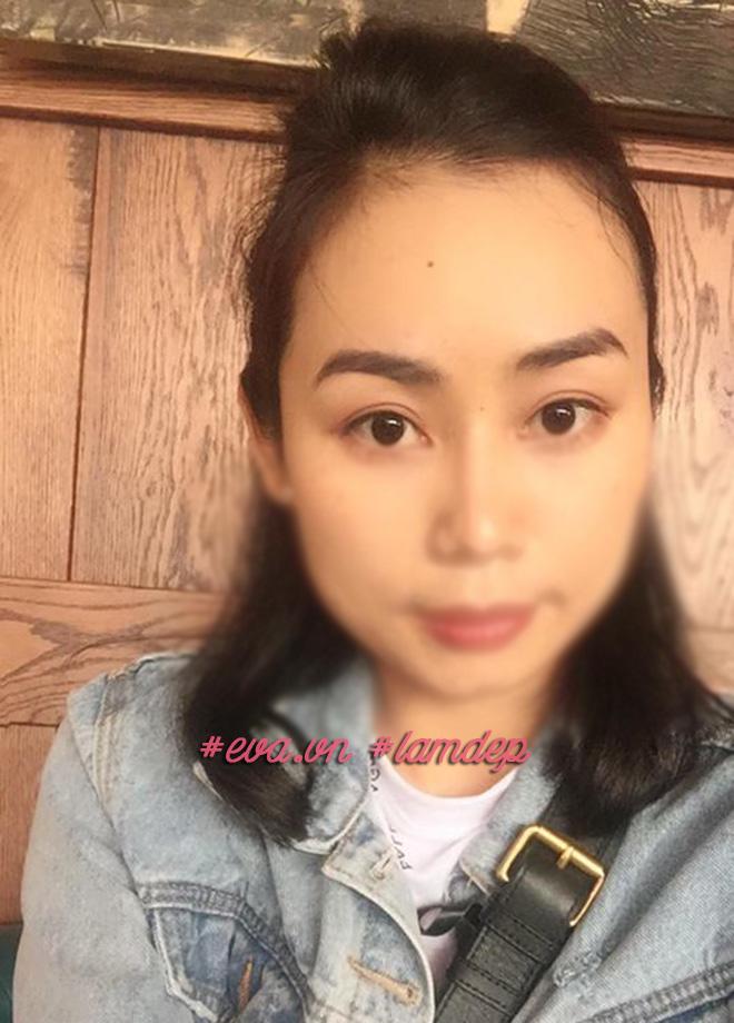 Nâng chân mày cải thiện nếp nhăn và mí sụp nhưng không chỉ dành cho phụ nữ trung niên! - 6