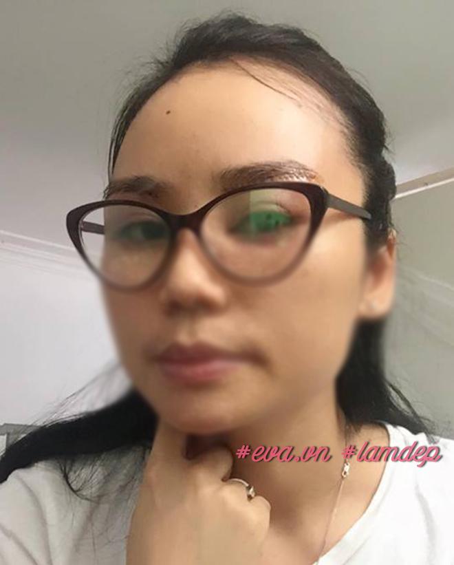 Nâng chân mày cải thiện nếp nhăn và mí sụp nhưng không chỉ dành cho phụ nữ trung niên! - 7