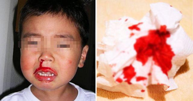 Thấy con chảy máu cam, mẹ trẻ liền làm điều này nhưng ngay sau đó hối hận tột cùng - 1