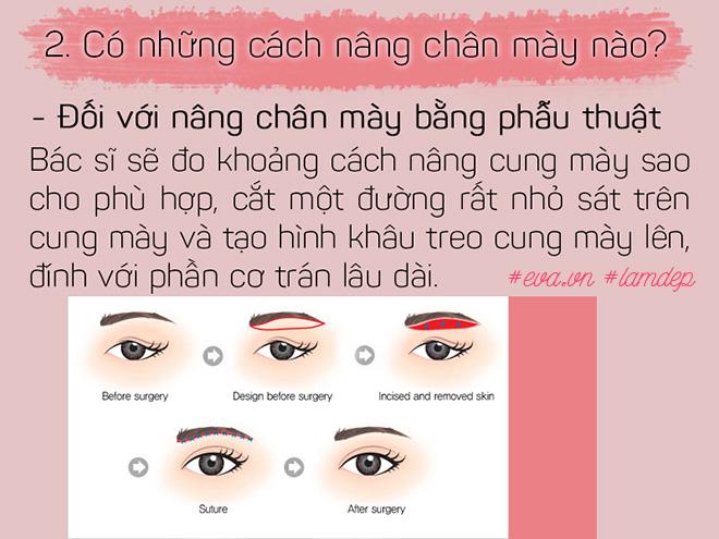 Bỏ 20 triệu chữa sụp mí bằng nâng cung chân mày, chị em nhận được gì? - 4