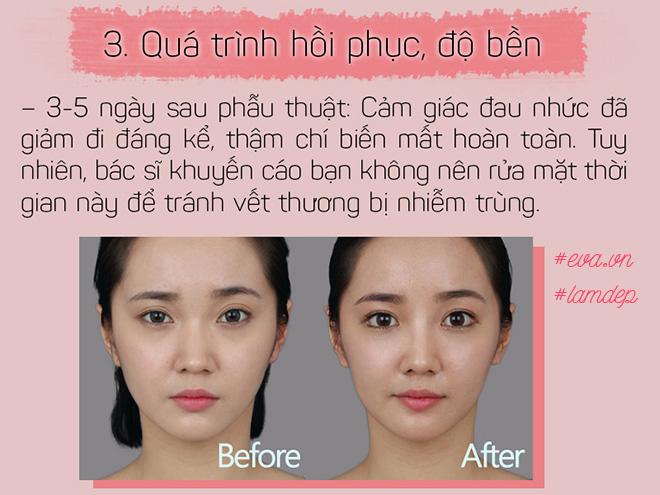 Bỏ 20 triệu chữa sụp mí bằng nâng cung chân mày, chị em nhận được gì? - 8