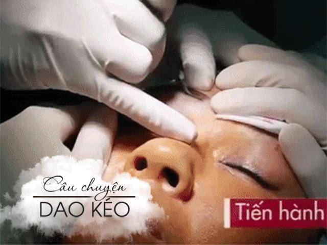 Bỏ 20 triệu chữa sụp mí bằng nâng cung chân mày, chị em nhận được gì?