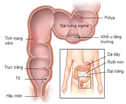 Con gái 3 tuổi có cục thịt thừa ở mông, mẹ thở phào khi kịp thời đưa tới bác sĩ - 2
