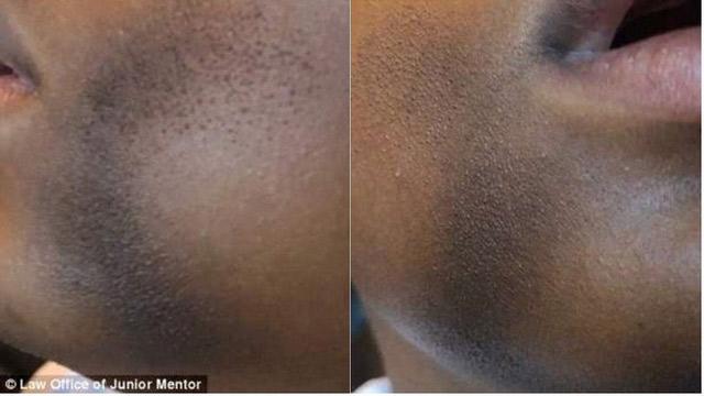 Con trai dị ứng 23 tháng không khỏi, mẹ nhớ lại buổi đi chơi công viên mới hiểu lý do - 3