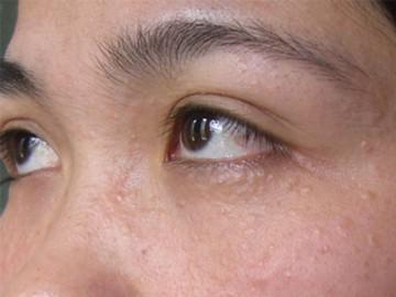 Mụn thịt có bám dai như đỉa cũng bị đánh bay với những công thức đơn giản dưới đây