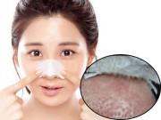 Làm đẹp - Các nàng sẽ dừng ngay việc dùng miếng dán lột mụn nếu biết những sự thật kinh khủng sau