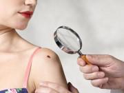 Sức khỏe - Chuyên gia mách kiểm tra ngay nốt ruồi trên cơ thể để nhận biết mắc ung thư hay không