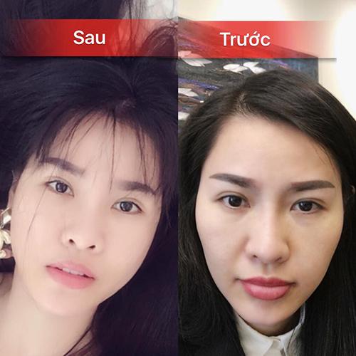 Quế Vân tiết lộ chi vài trăm triệu làm đẹp, công khai sang Hàn phẫu thuật lần thứ 6 - 5