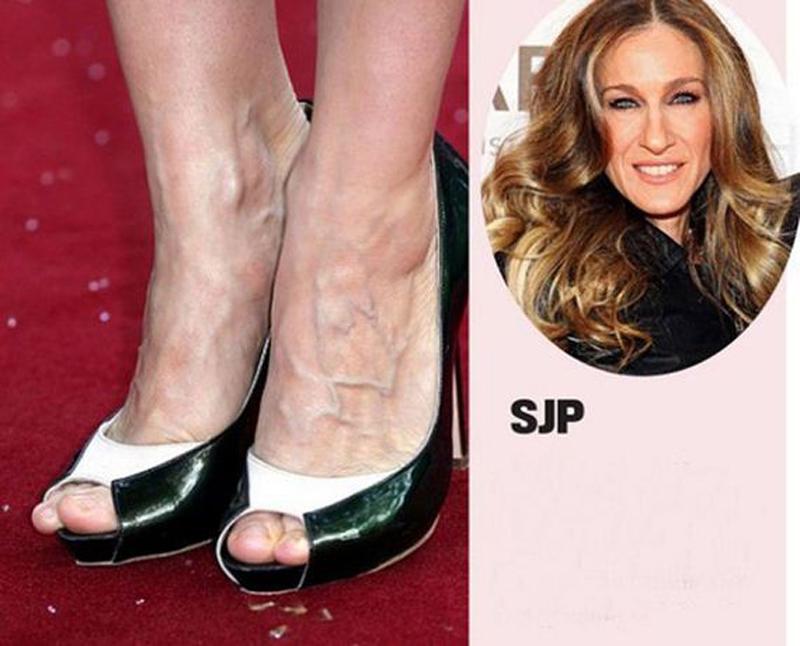 Sarah Jessica Parker cũng khiến đôi chân tổn thương nặng nề khi nghiện giày cao.
