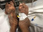 Sức khỏe - Tự ý uống thuốc giảm đau nhiều năm, người đàn ông nhập viện vì tay, chân biến dạng