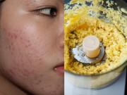 Làm đẹp - Hóa ra cách trị sẹo thâm trên mặt chỉ tóm tọn trong đống gia vị tủ bếp thôi sao!
