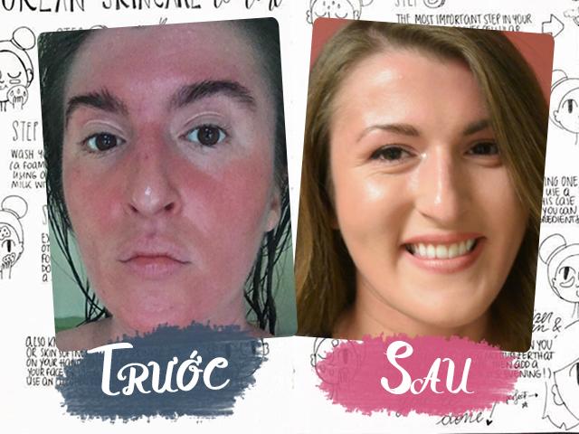 Da khô, mẩn đỏ, cô gái đã theo chu trình dưỡng da 6 bước của Hàn và nhận kết ngọt!