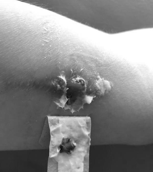 Cấy que tránh thai, mẹ đau đớn vì nhiễm trùng suốt 4 tháng, muốn lấy ra cũng không được - 2