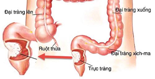 Bị ung thư trực tràng vì ăn cay buổi tối: ghi nhớ 6 “không” trong bữa tối tránh rước bệnh - 2