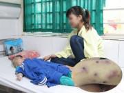 Sức khỏe - Tưởng con đỡ bệnh thủy đậu, gia đình xin ra viện, ai ngờ biến chứng lở loét toàn thân