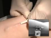 Bà bầu - Cấy que tránh thai, mẹ đau đớn vì nhiễm trùng suốt 4 tháng, muốn lấy ra cũng không được