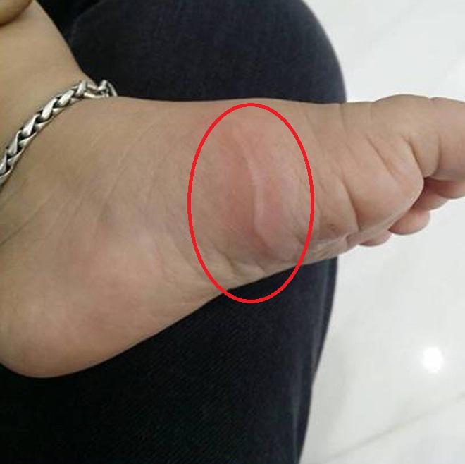 Thấy chân con nổi vệt đỏ ngoằn ngoèo như giun, người cha giật mình khi biết bệnh con mắc phải - 1