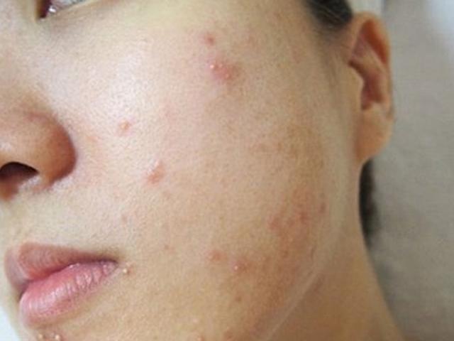 Đắp mặt nạ giữ ẩm 2 lần/ngày, cô gái tá hỏa vào viện gấp vì mặt đỏ ửng, ngứa ngáy