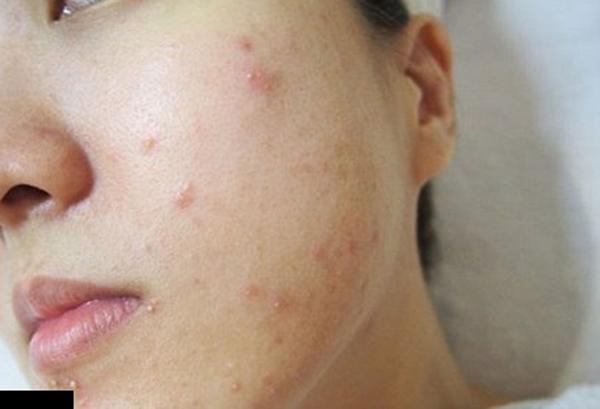 Đắp mặt nạ giữ ẩm 2 lần/ngày, cô gái amp;#34;tá hỏaamp;#34; vào viện gấp vì mặt đỏ ửng, ngứa ngáy - 1