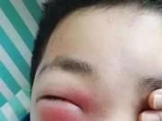 Sức khỏe - Cậu bé 11 tuổi mắt sưng như trứng, suýt mù vì bố mẹ cho nghịch điện thoại suốt 2 ngày