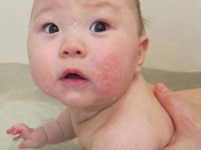 “Bật mí ” bài thuốc Nam chữa mề đay ở trẻ em an toàn, hiệu quả - 1