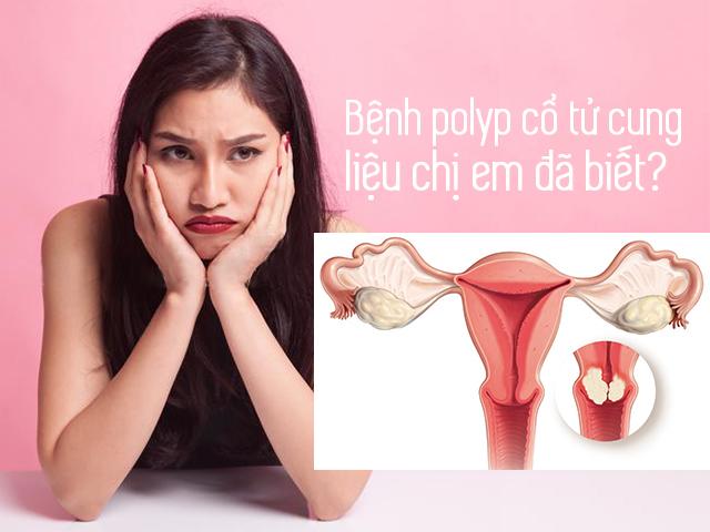 Polyp cổ tử cung - chị em nhất định phải biết - 1