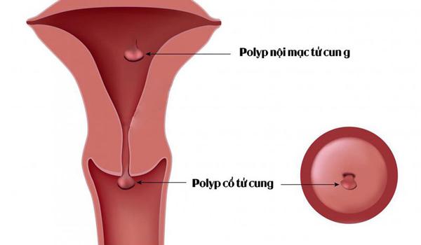 Polyp cổ tử cung - chị em nhất định phải biết - 3