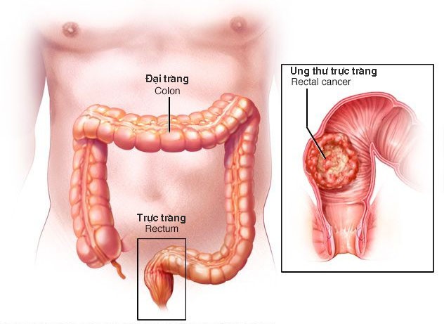 Ung thư đường tiêu hóa, họa từ những món ăn quen thuộc - 1