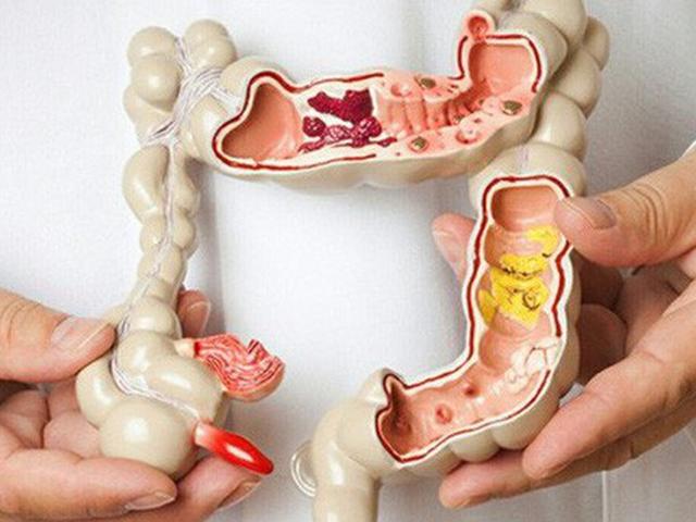 5 dấu hiệu báo động ung thư đại trực tràng, điều số 1 nhiều người từng mắc nhưng chủ quan