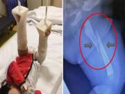 Làm mẹ - Bé 3 tháng khóc không ngừng khi đi nhà trẻ về, bố sốc nặng khi nghe bác sĩ kết luận