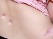 Sức khỏe - Bé gái bị teo hết da vùng tiêm khi đến thẩm mỹ viện trị sẹo lồi thuỷ đậu