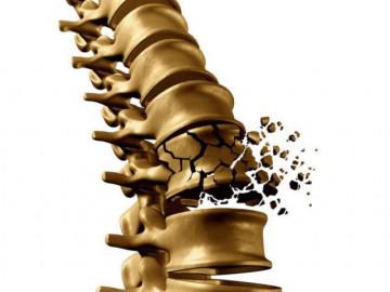 Bệnh loãng xương đang trẻ hóa, liệu bạn đã biết cách phòng ngừa?