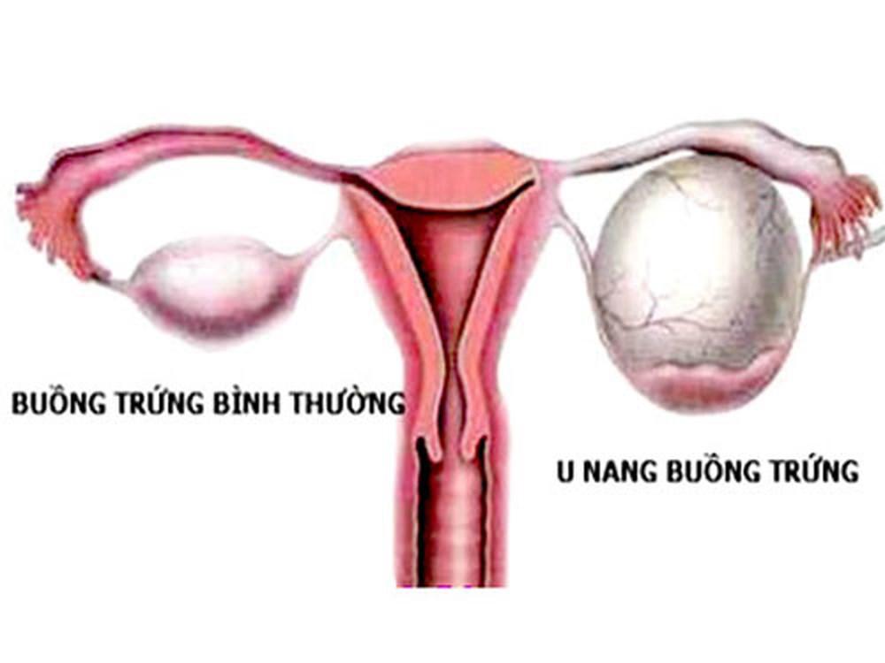 Triệu chứng u nang buồng trứng chị em nhất định phải ghi nhớ - 2