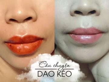 Cùng đi phun môi: người thì lành nhanh màu lên đẹp, người lại khổ sở đau đớn mất tiền oan!