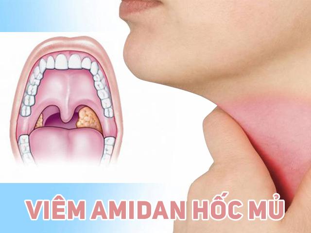 Viêm amidan hốc mủ là bệnh gì? Liệu bạn đã biết rõ