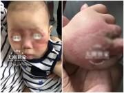 Sức khỏe - Đưa con ra công viên chơi, mẹ "tá hỏa" khi vài ngày sau mặt con phồng rộp, mưng mủ