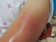 Làm mẹ - Bé 3 tuổi bị mẹ đổ nước nóng vào tay, chồng sau khi biết lý do lại đồng tình