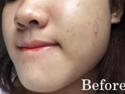 Làm đẹp - 2 cách trị mụn ẩn tại nhà hiệu quả nhất, thay thế cả đống mỹ phẩm đắt tiền