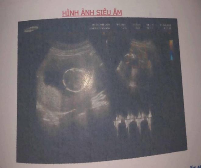 Khánh Đơn thông báo vợ trẻ hot girl mang bầu con gái, gặp rắc rối vì thai to - 1