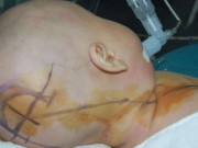 Làm mẹ - Bé 4 tháng bị tràn dịch não vì cách chăm sóc sai lầm nhiều mẹ Việt hay mắc