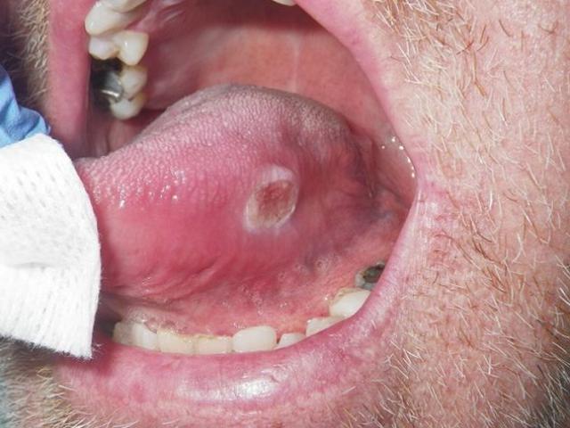 Mụn bọc mọc trong lưỡi chữa mãi không khỏi vì thói quen đếm tiền nhiều người mắc