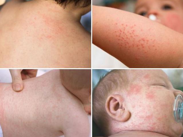 Sốt phát ban ở trẻ em: Nguyên nhân, dấu hiệu nhận biết và cách chăm sóc bé tại nhà