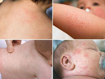 Sốt phát ban ở trẻ em: Nguyên nhân, dấu hiệu nhận biết và cách chăm sóc bé tại nhà