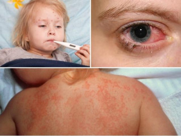 Sốt siêu vi: Nguyên nhân, triệu chứng và cách chữa trị khi trẻ mắc phải