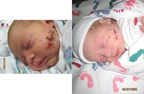 Xót xa những em bé sơ sinh bị bác sĩ mổ đẻ trúng người - 4