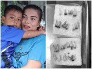 Làm mẹ - Bé 4 tuổi thường xuyên uống sữa đêm phải làm phẫu thuật nhổ 18 chiếc răng sâu