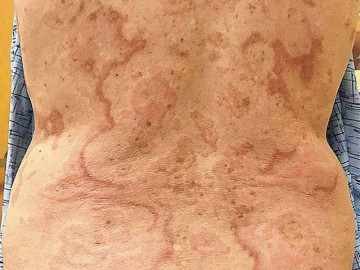 Da nổi ban kỳ lạ, người phụ nữ đi khám phát hiện ung thư ở nơi không ai ngờ tới