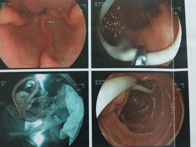 Cặp giun đũa dài 20cm sống trong tá tràng người phụ nữ vì thói quen ăn uống nhiều người mắc
