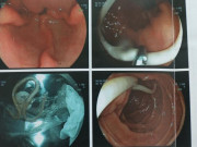 Sức khỏe - Cặp giun đũa dài 20cm sống trong tá tràng người phụ nữ vì thói quen ăn uống nhiều người mắc