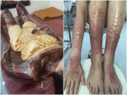 Làm đẹp - Đi tắm trắng, cô gái khiến cả mạng xã hội hốt hoảng vì da trông như... phỏng nặng